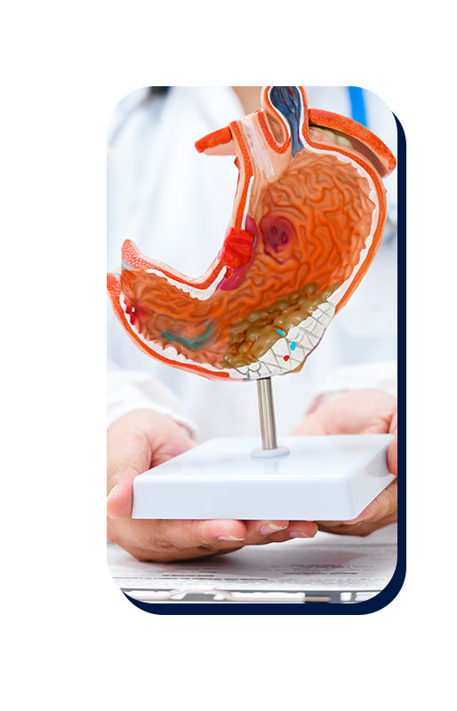 modelo bypass gastrico