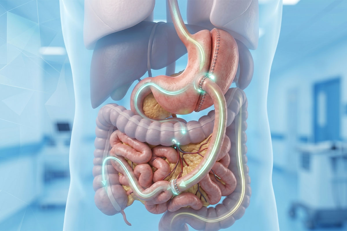 Procedimiento Cirugía Bariátrica de Bipartición intestinal en Monterrey
